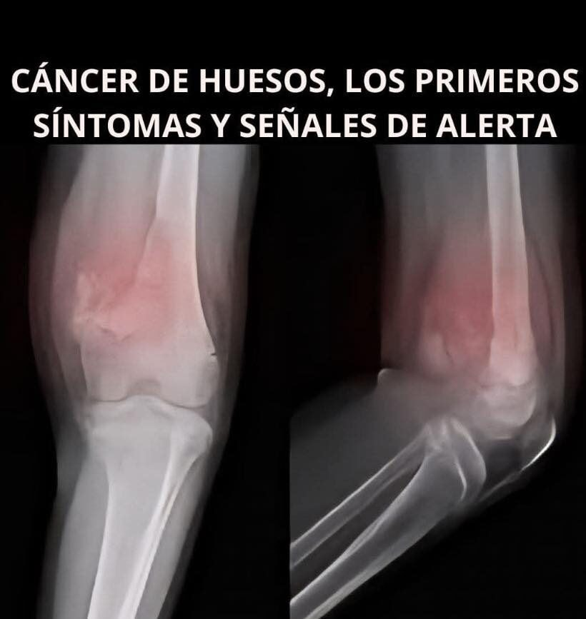 c-ncer-de-huesos-s-ntomas-y-se-ales-de-alerta-que-no-debes-ignorar